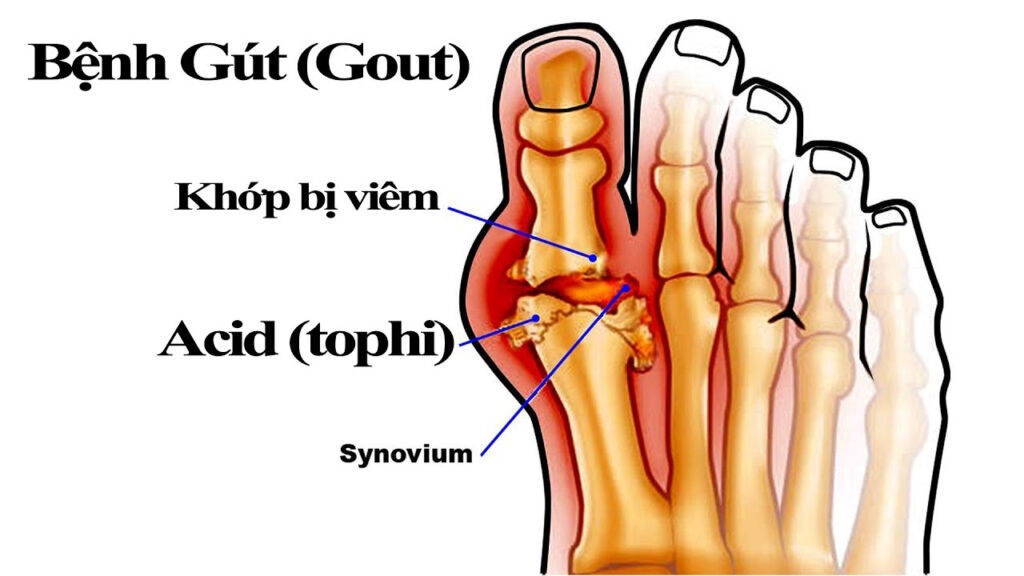 Viên uống đặc trị gút - gout Feburic Tablet 10mg Nhật Bản 10 vỉ x 14 viên